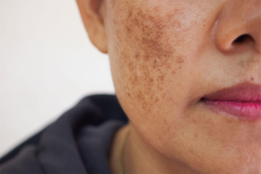 Melasma